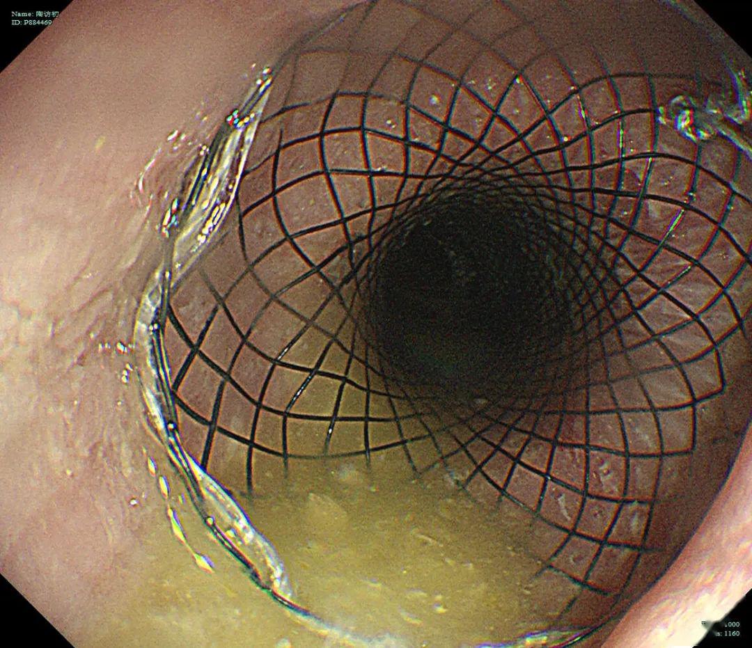 为你打开一扇门记特殊时期2例消化道恶性狭窄支架植入术