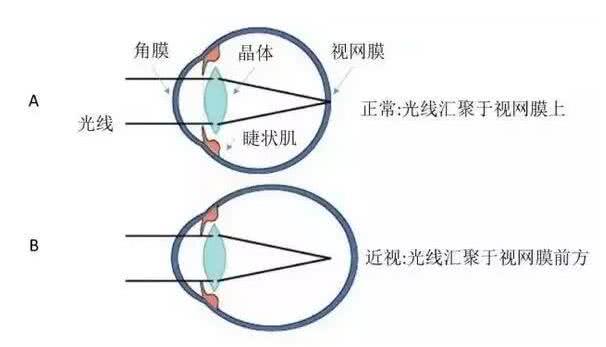 都是看不清,近视,散光,弱视有啥区别?