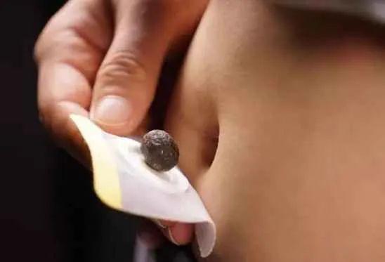 脐疗有“脐”效，脐丸莫小瞧！