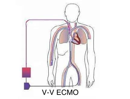 探究救命神器ecmo