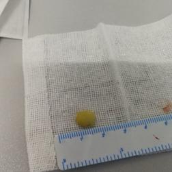 『孩子』手术一个小时才取出!别给孩子吃这些东西了!荆州1岁幼童吃夏威夷果被卡