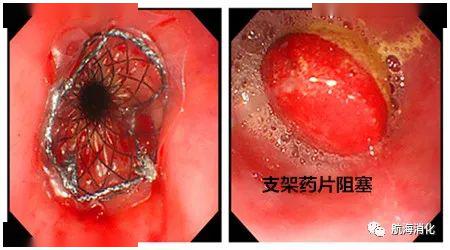 食管支架后应注意的12个问题