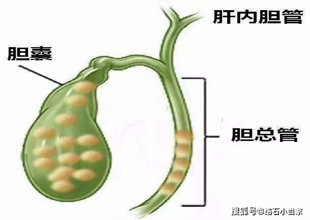 (2)术中证实胆总管有病变,如术中胆道造影证实或扪