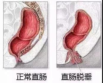 当肠腔内的肛管,直肠粘膜层松弛时,由于受到重力影响就会出现堆积的