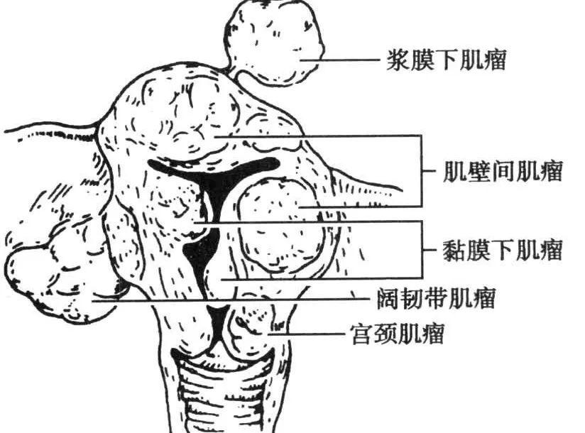 【女性课堂】带你了解子宫肌瘤的"前世今生"