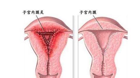 关于细菌性阴道炎女性应该知道的一些知识