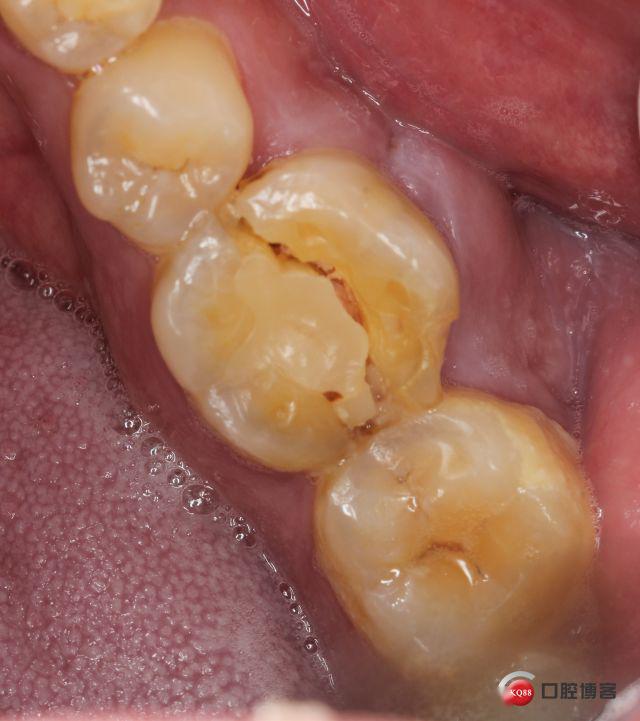 根管治疗后牙齿劈裂拔除一例