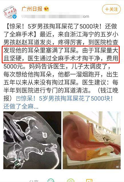 「宝宝」这种不仅不能掏，还对宝宝有好处宝宝的耳屎有两种