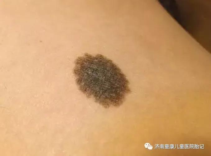 浅咖啡色胎记怎么去除 咖啡色胎记偏方
