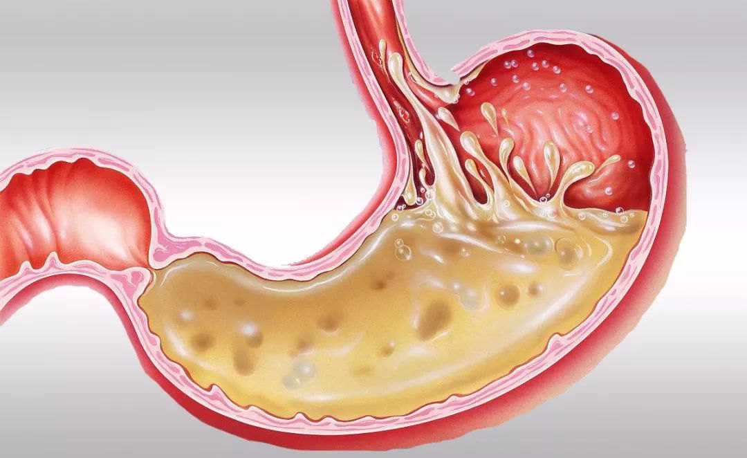 胃酸太多或过少,健康的胃就没有