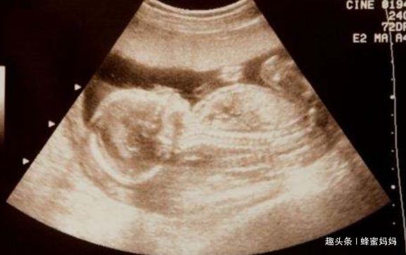 一般多久怀孕会出现恶心的现象 63248efcffb5409cbace0593677999f7.png