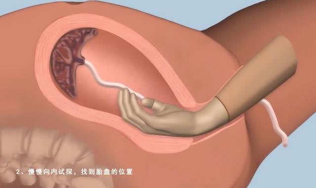 ② 医生的手在里面试探寻找，顺着脐带的方向找到胎盘； 医生会把整只手伸入妈妈子宫内；