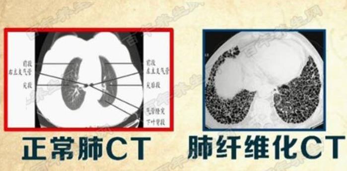 支气管炎肺纤维化的综合治疗