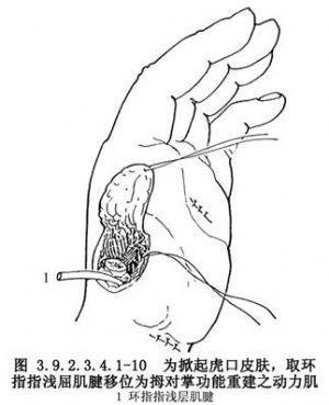 拇指再造术_手指