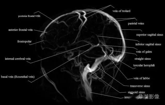 高清头颅静脉系统解剖必点收藏