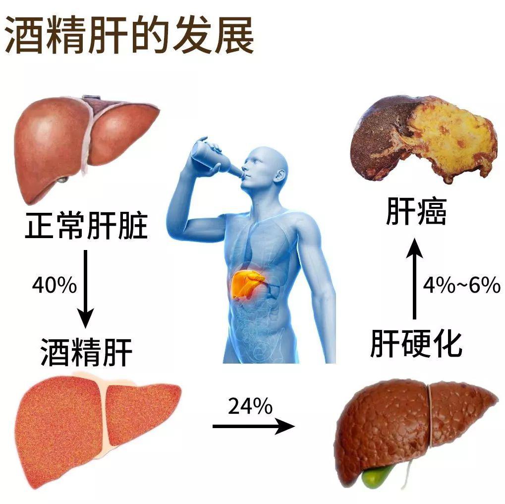 酒精肝会变成肝癌这还真不是吓唬你