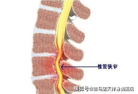 腰椎管狭窄有哪些症状?