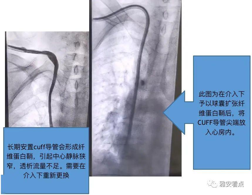 看到血管内部情况,以球囊扩张纤维蛋白鞘后,将cuff导管尖端放入心房内