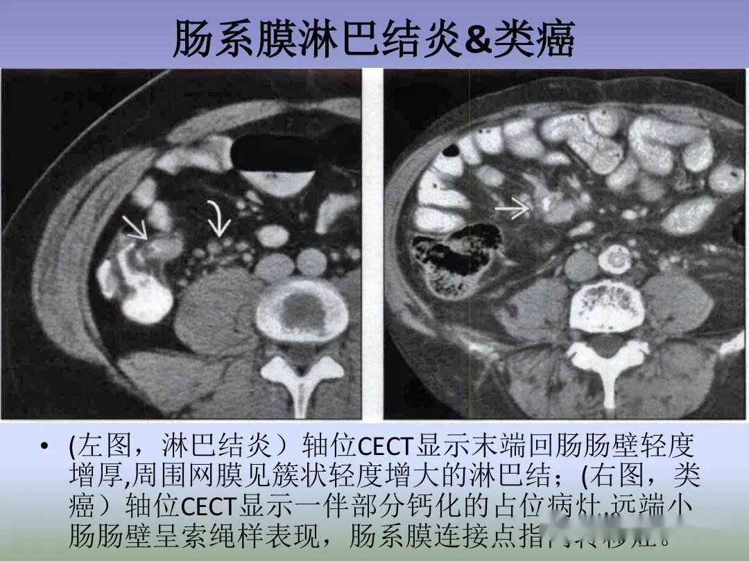 回盲部占位或炎症的影像鉴别诊断