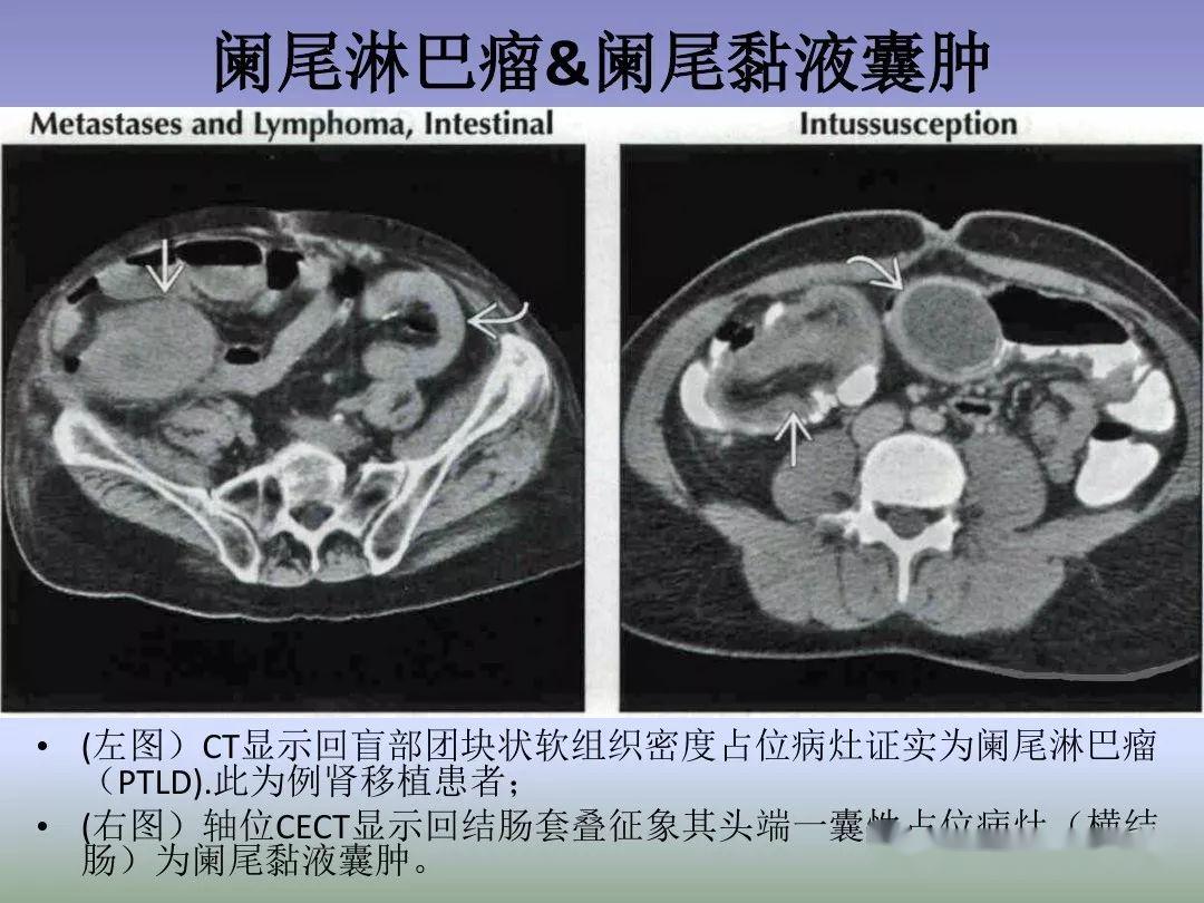 回盲部占位或炎症的影像鉴别诊断