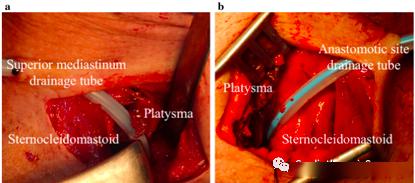 上纵隔引流管位置(颈部右侧). b:吻合口引流管位置(颈部左侧).