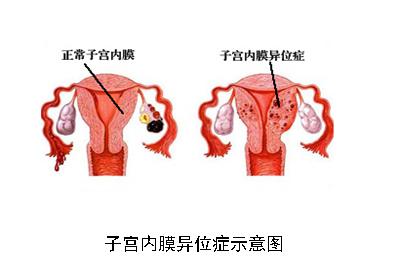 备孕路上的"杀手"----子宫内膜异位症