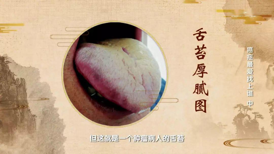 中医告诉你：痰湿是什么？
