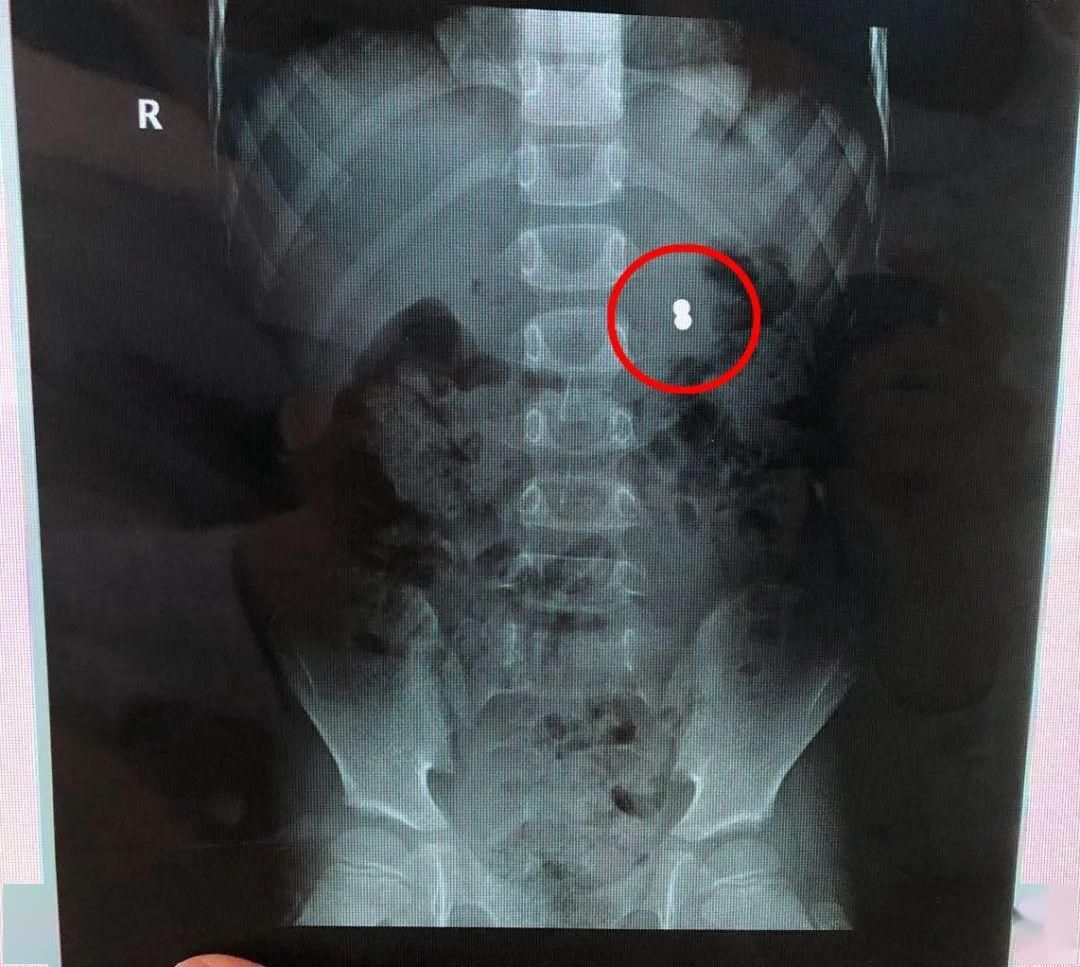 【胃部】去医院后发现还有更严重的……你还在给孩子玩这种玩具吗？6岁男孩因它胃部差点穿孔