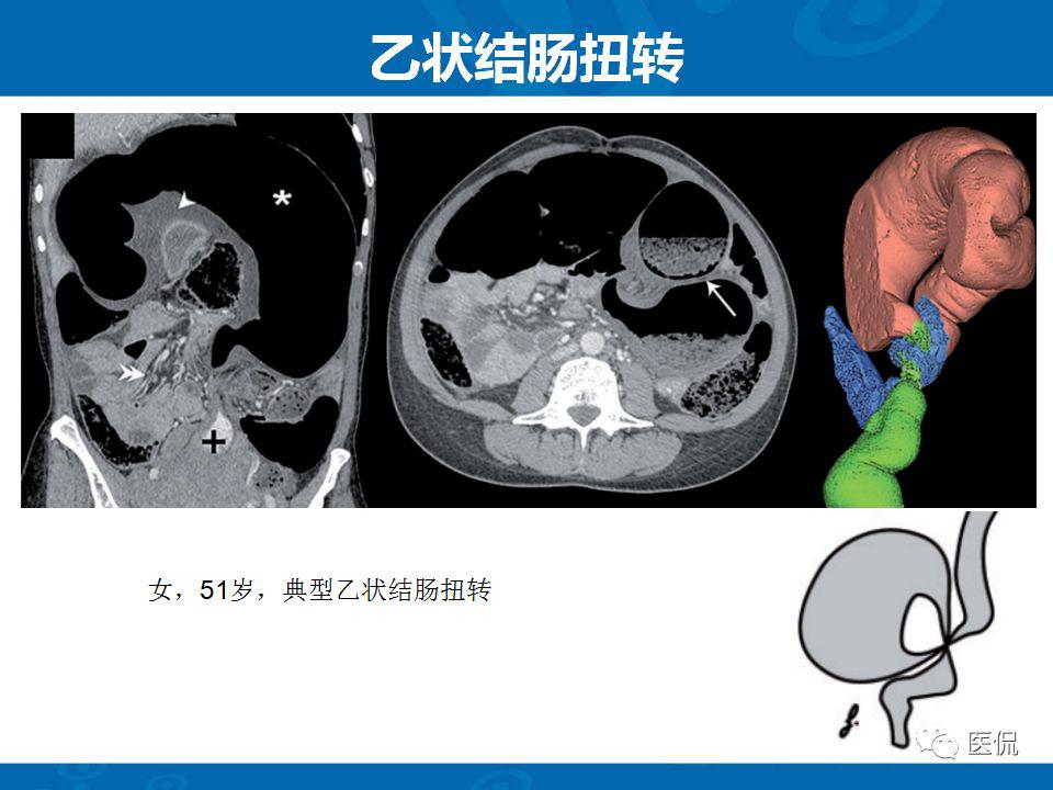 结肠扭转ct诊断