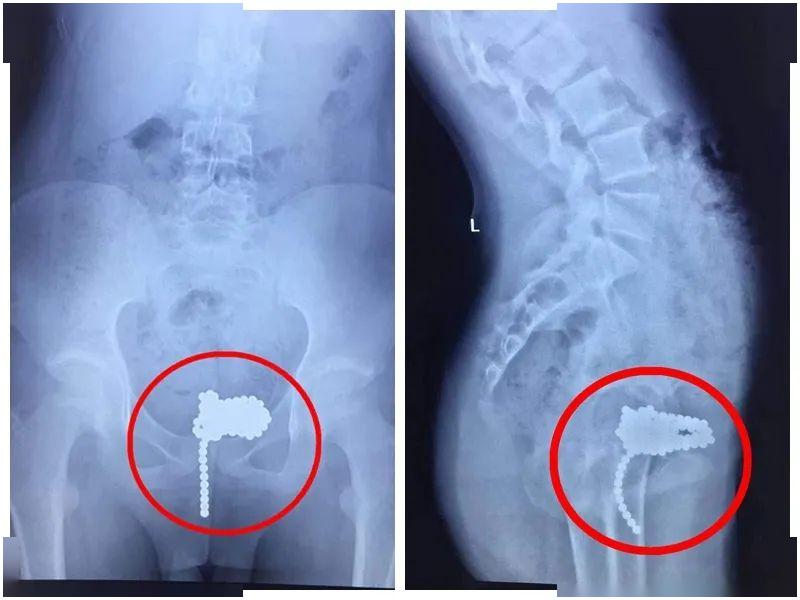 【胃部】去医院后发现还有更严重的……你还在给孩子玩这种玩具吗？6岁男孩因它胃部差点穿孔