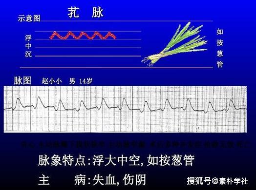 脉诊的核心部分正常脉象与病理脉象各是什么触感