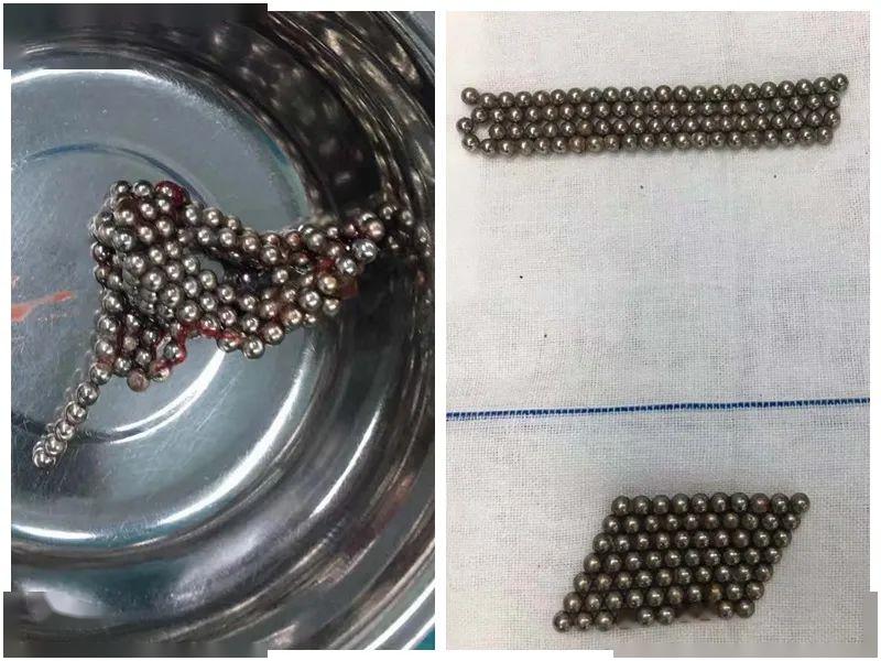 【胃部】去医院后发现还有更严重的……你还在给孩子玩这种玩具吗？6岁男孩因它胃部差点穿孔