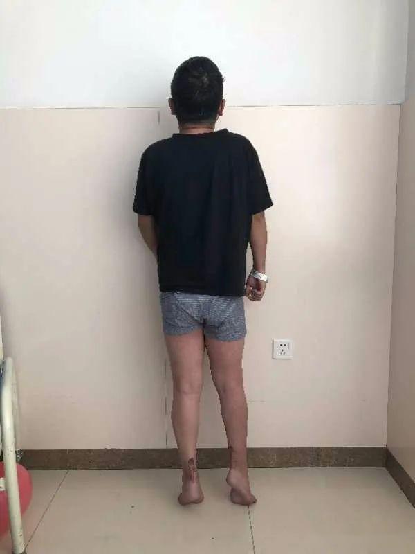 骨一科完成多例肢体残疾疑难手术 助力残疾人健康_畸形