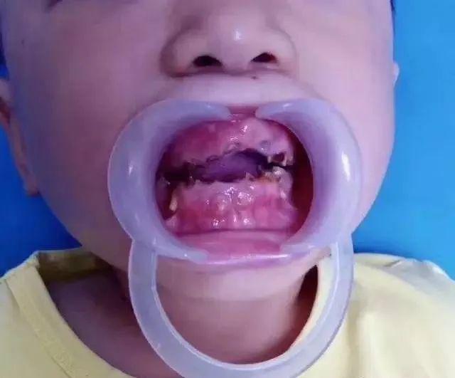 正常情况下,小孩子有20颗牙齿.