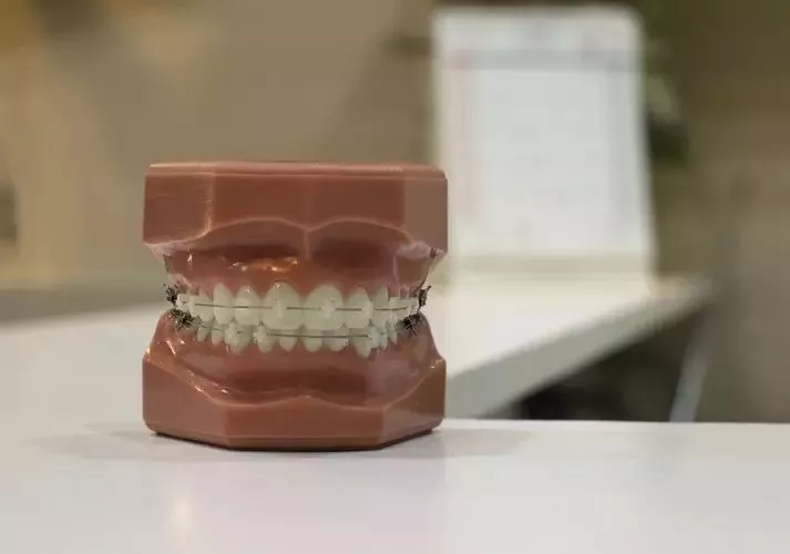 一次性解答你经常问的14个牙齿矫正问题!
