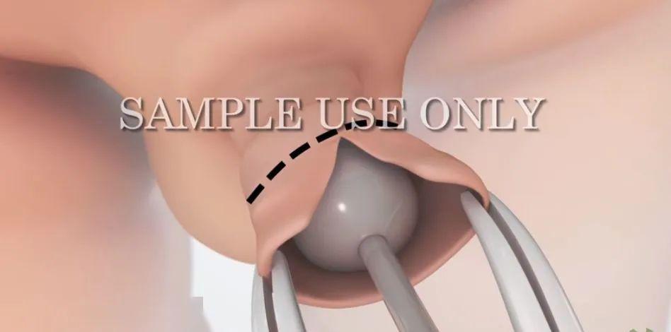 「私处」小男孩的私处也需要护理!家长们别忽视