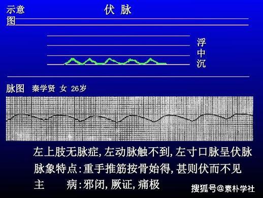 脉诊的核心部分:正常脉象与病理脉象各是什么触感?