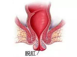 直肠脱垂可以自行恢复吗?