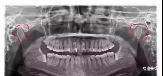 石家庄牙齿矫正郑希医生 | 偏侧咀嚼都有哪些危害