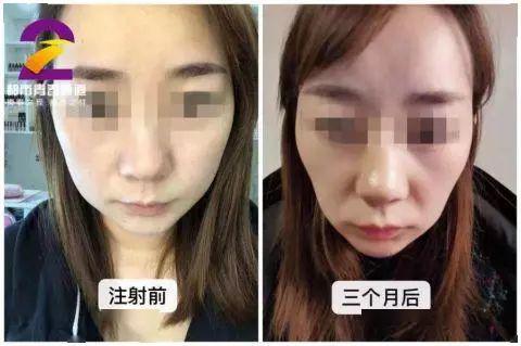 可怕!西安一女子听朋友介绍去打瘦脸针,结果脸塌了