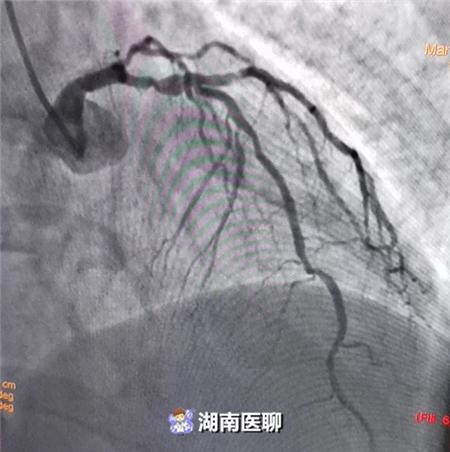 性狭窄,前降支近段可见约95%弥漫性狭窄,近段发出第一对角支之前可