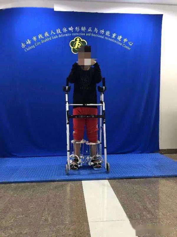 骨一科完成多例肢体残疾疑难手术 助力残疾人健康_畸形