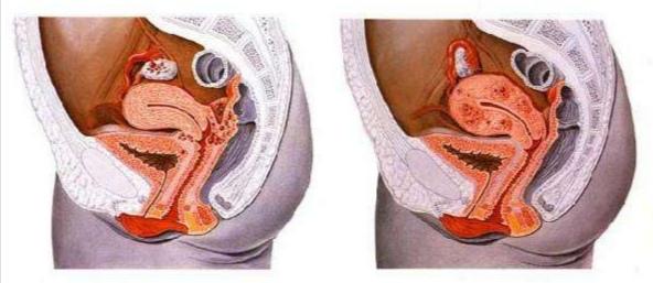 备孕路上的"杀手"----子宫内膜异位症