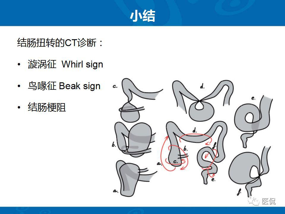 结肠扭转ct诊断