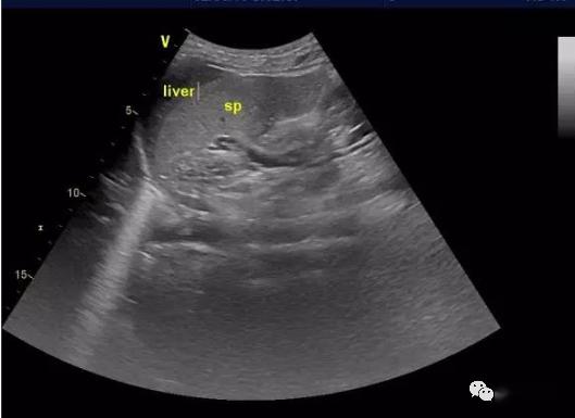 獭尾肝超声诊断