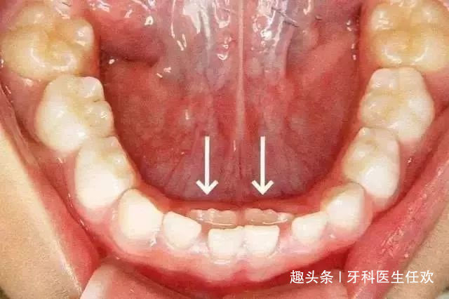 #乳牙#原因是家长们喂出来的！10个孩子里面有5个孩子长双排牙