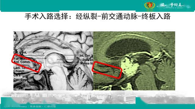 经纵裂前交通动脉终板入路三脑室颅咽管瘤切除术