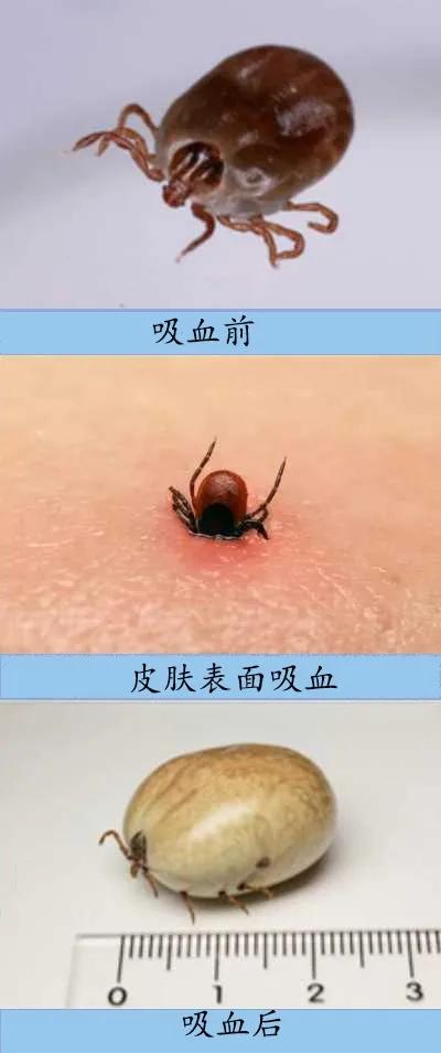 出现"发热"症状当心蜱虫病   目前认为,蜱是该病的传播媒介, 蜱叮咬