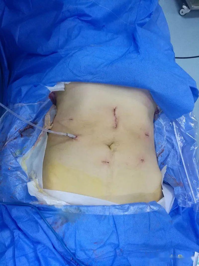 2019年,胃肠腹壁疝外科实施手术1969台次,成功开展了黔西南州首例直