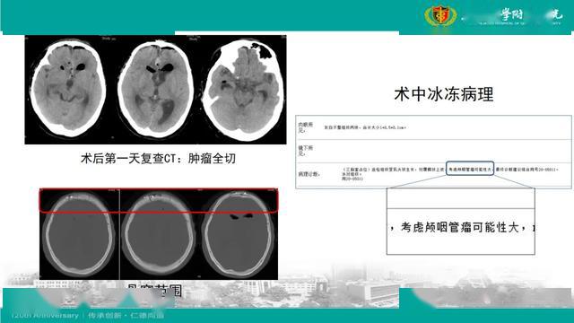 经纵裂前交通动脉终板入路三脑室颅咽管瘤切除术